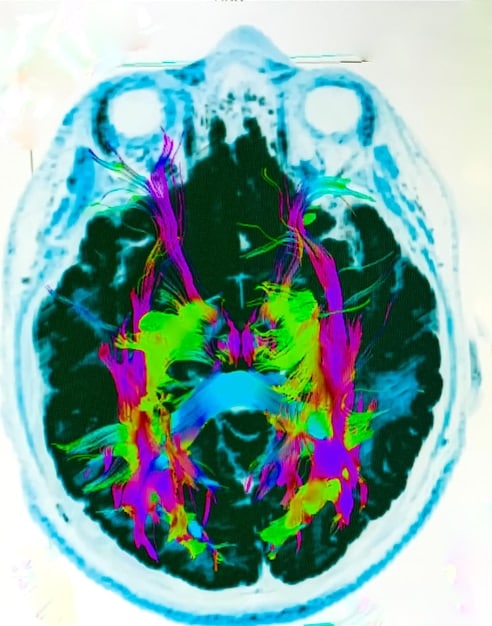 A brain scan highlighting active areas, with an overlay showing neural pathways becoming tangled or stressed, symbolizing the neurobiological impact of trauma.